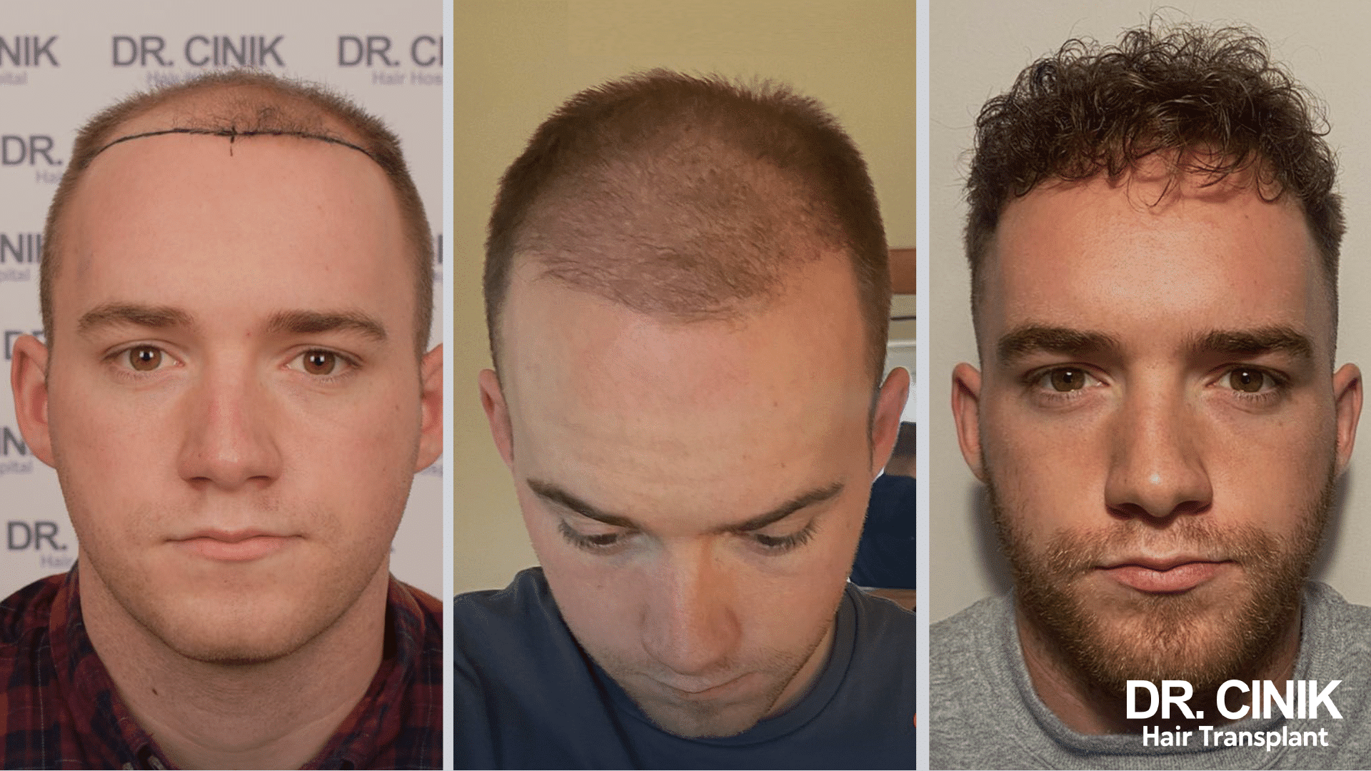 Trapianto di capelli di Claron, prima e dopo, 4100 innesti Sapphire FUE, risultato a 9 mesi