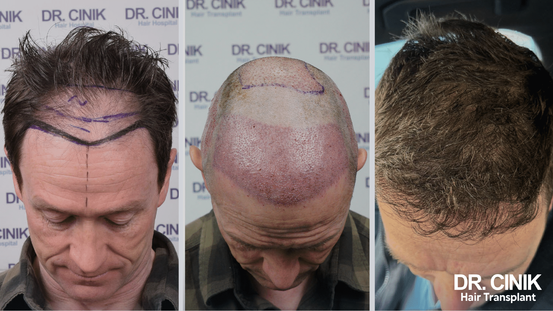 Greffe de cheveux de Gerry, avant après, 4000 greffons, résultat DHI en Turquie