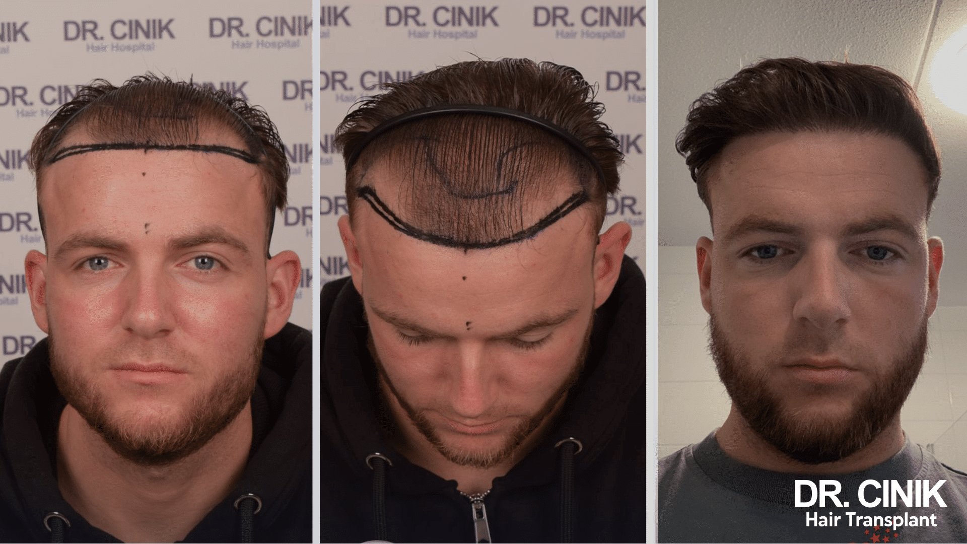 Larsee's hair transplant before and after, Sapphire FUE, 2700 grafts, 9-month result