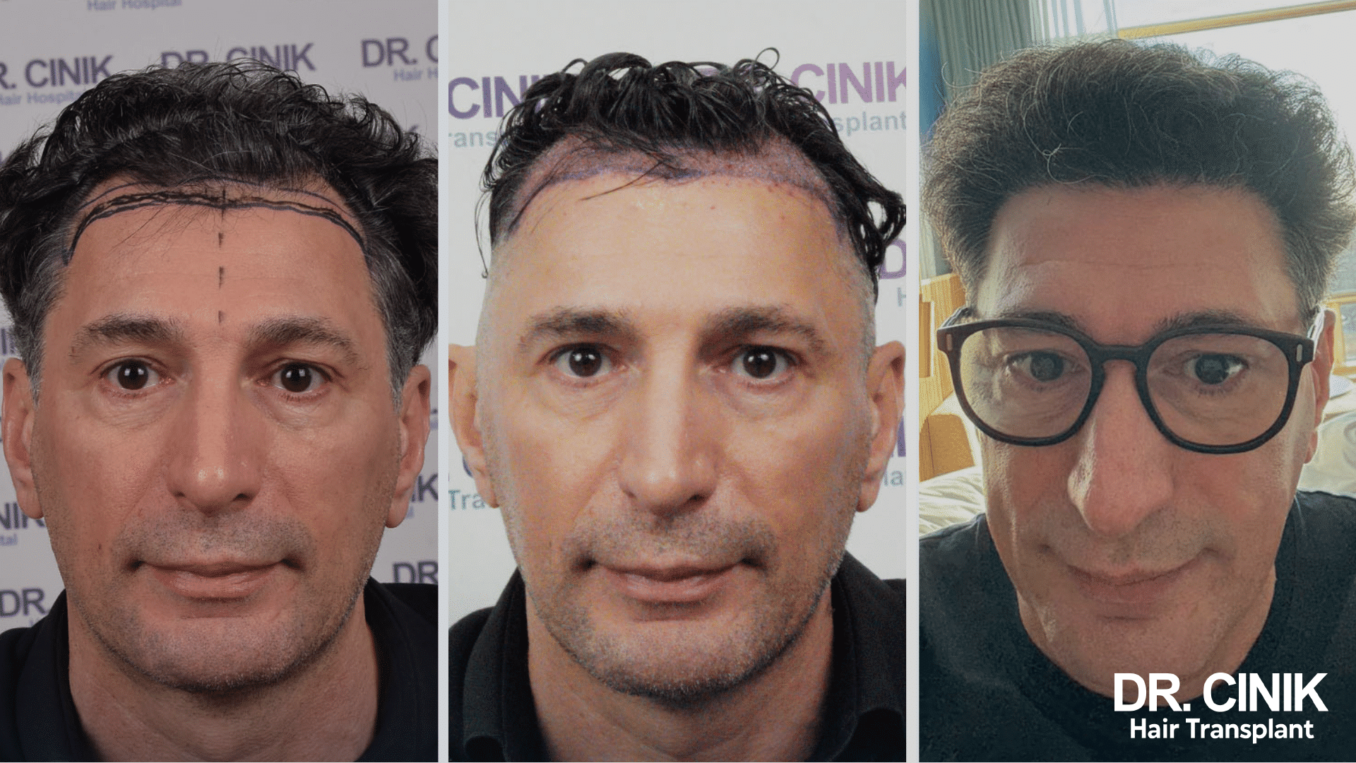 Greffe de cheveux de Moncef, avant après, 5000 greffons, résultat saphir FUE en Turquie