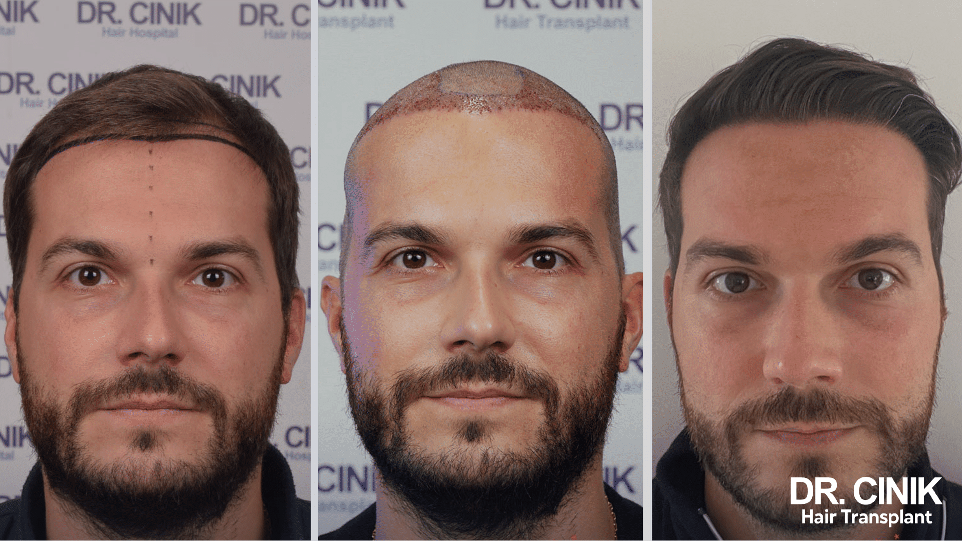 Trapianto di capelli DHI di Xavier, prima e dopo, 2450 innesti, risultato a 12 mesi