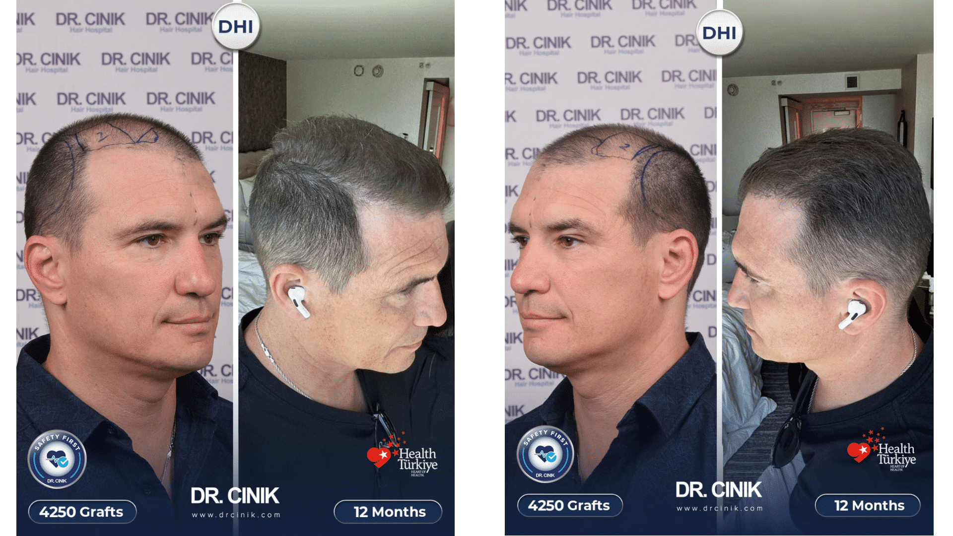Andrei's hair transplant result at 12 months, 4250 grafts DHI, restored hairline and temples