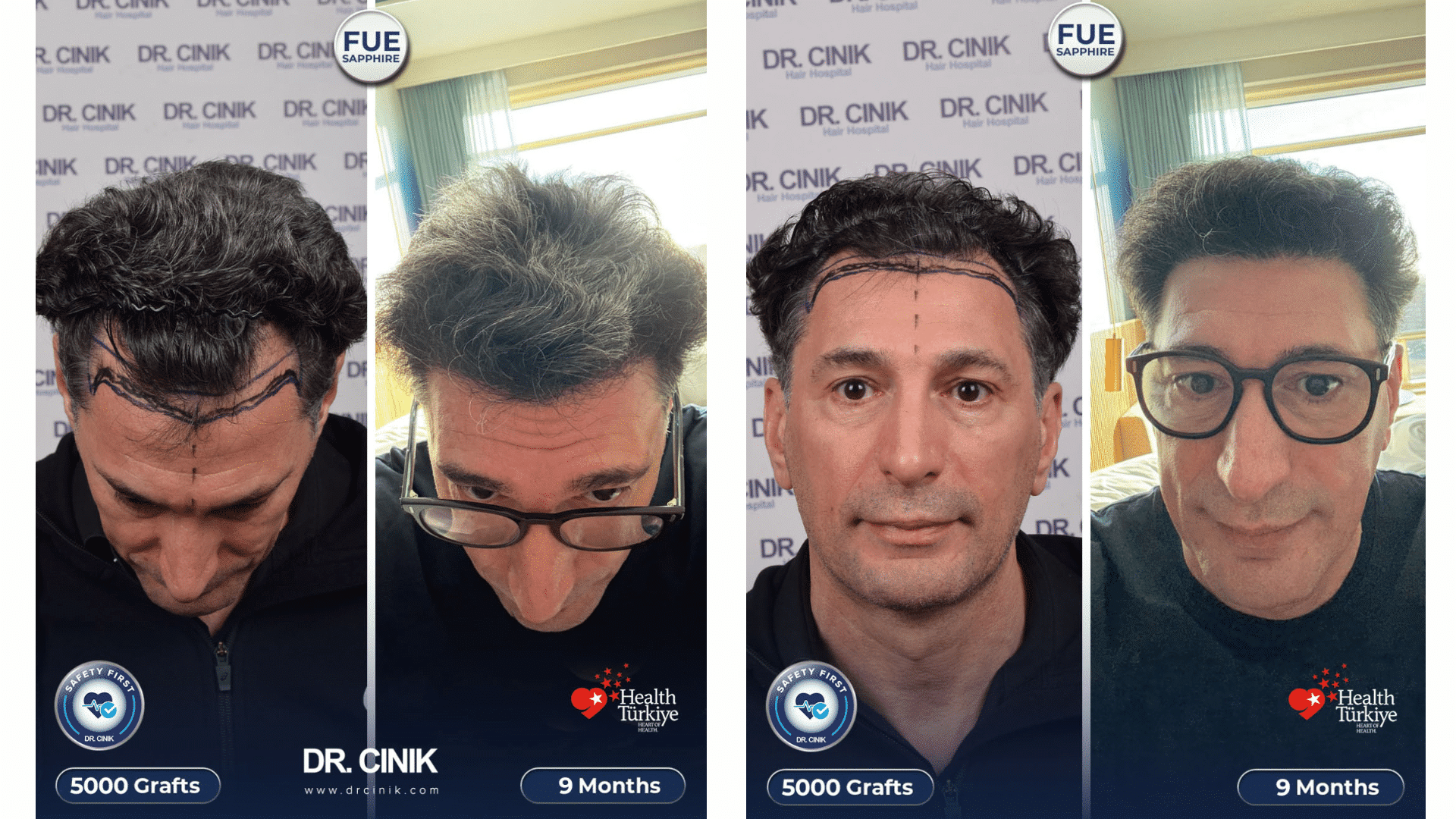 Moncef's hair transplant before and after at 9 months, 5000 grafts, Sapphire FUE result in Turkey