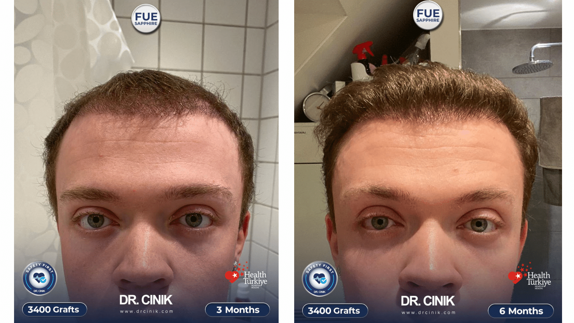 Mikkel's hair transplant regrowth at 3 and 6 months, 3400 grafts Sapphire FUE