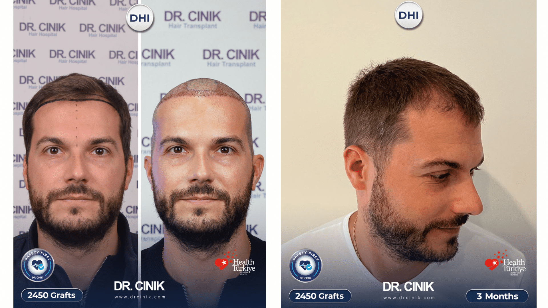 Trapianto di capelli di Xavier, giorno dell'impianto e ricrescita a 3 mesi, 2450 innesti