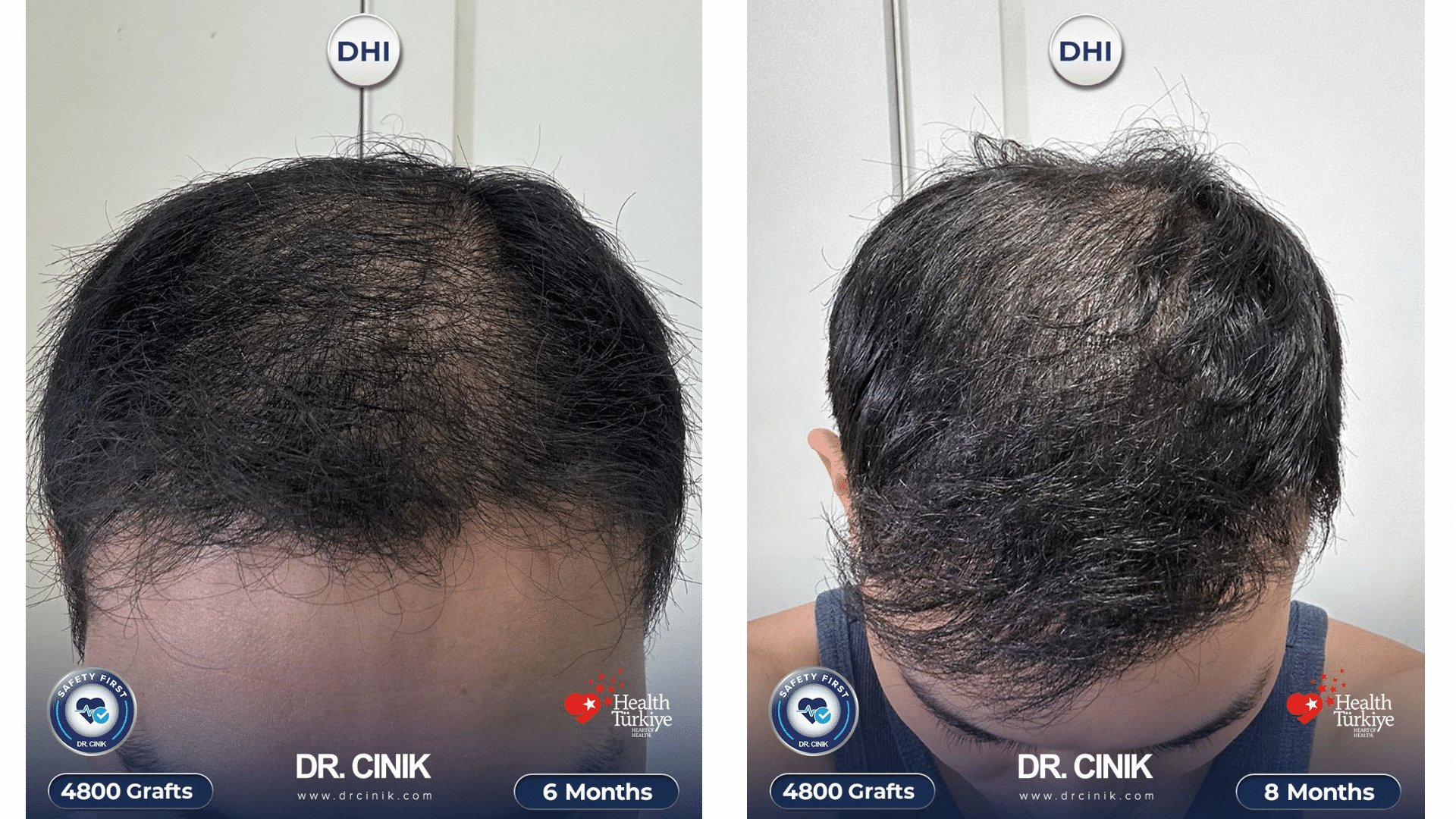 Risultato del trapianto di capelli di Jillo, 4800 innesti, a 6 e 8 mesi