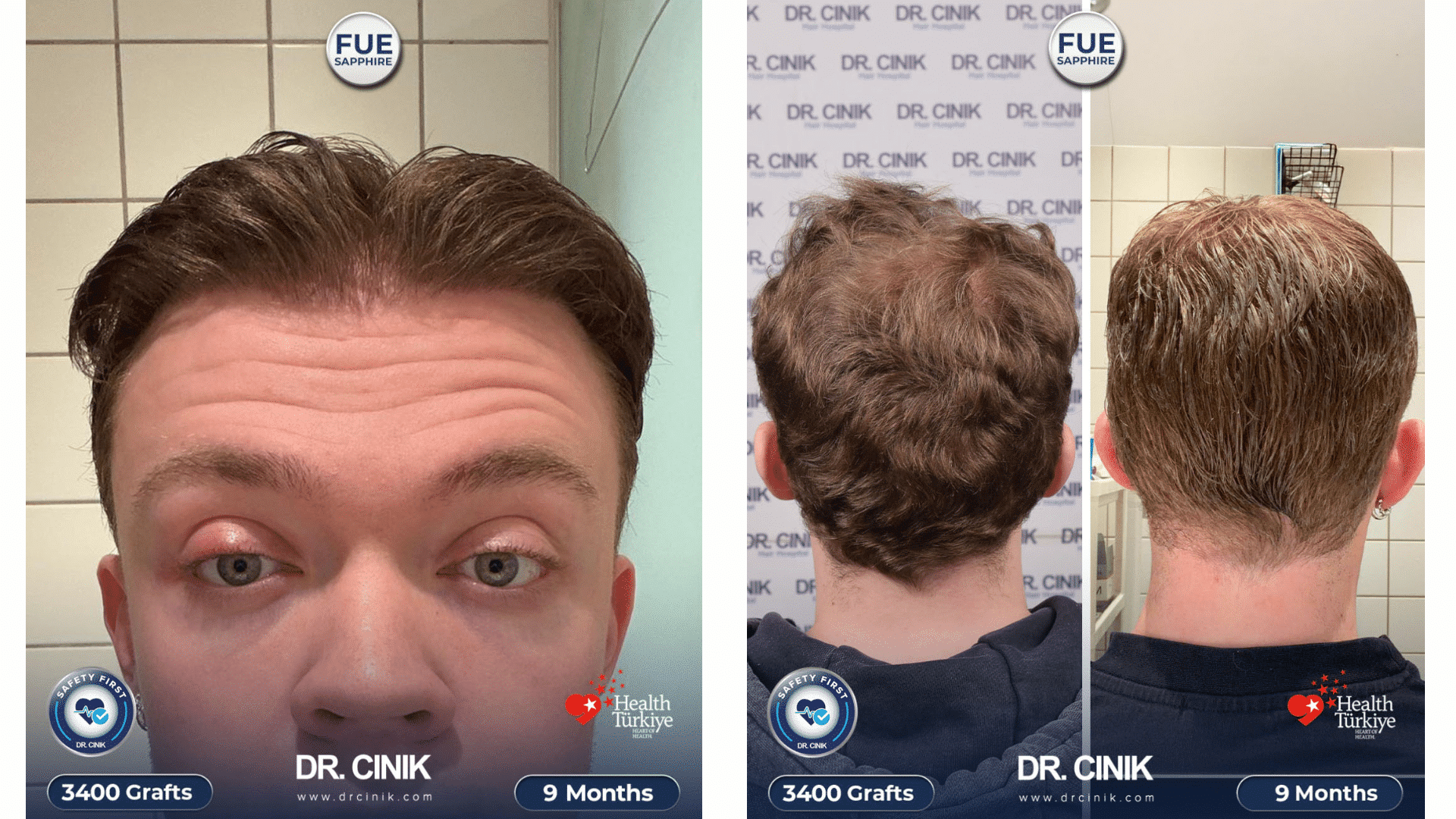 Mikkel's hair transplant result at 9 months, 3400 grafts Sapphire FUE, dense frontal hairline