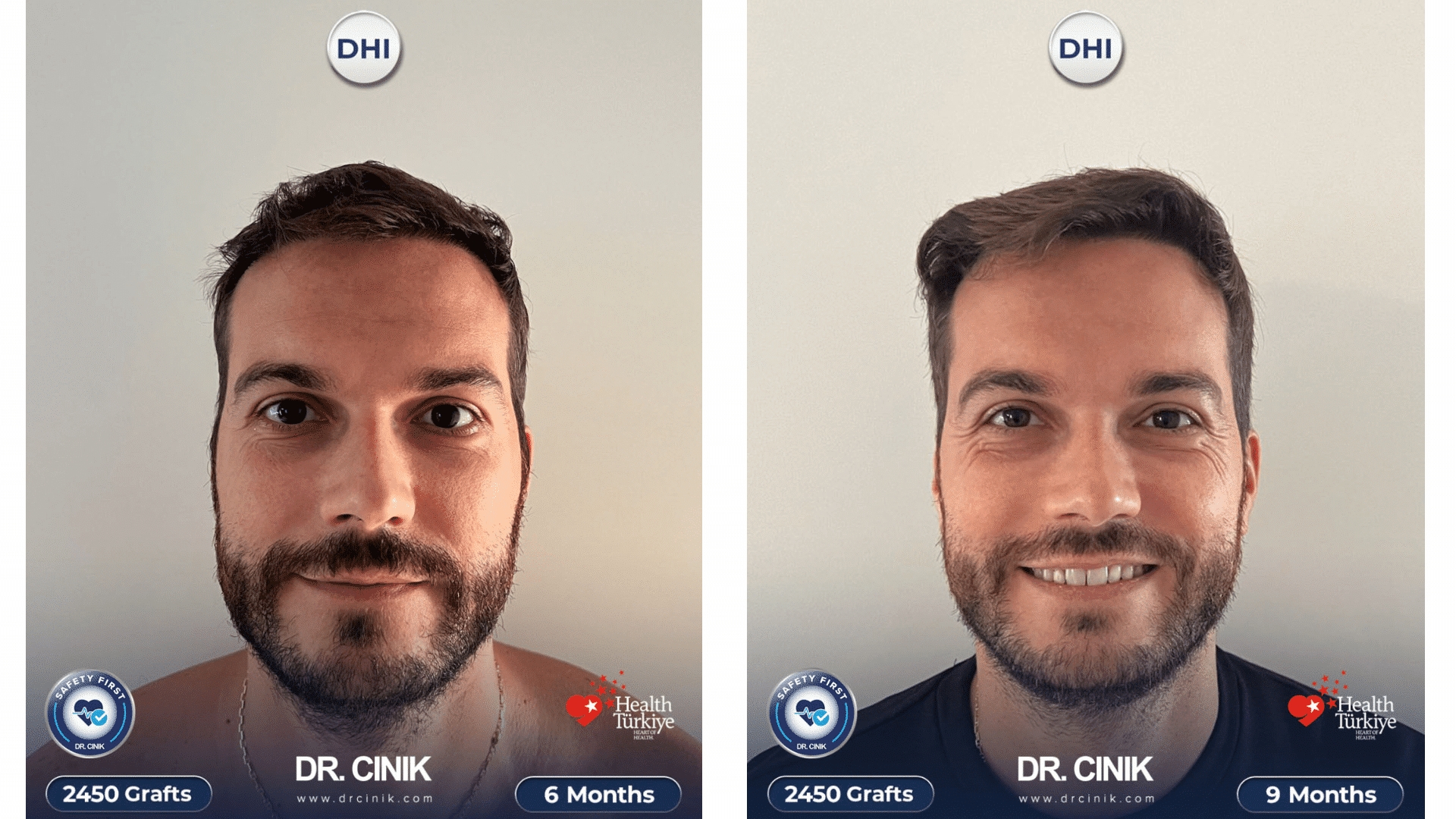 Greffe de cheveux de Xavier, progression à 6 et 9 mois, 2450 greffons