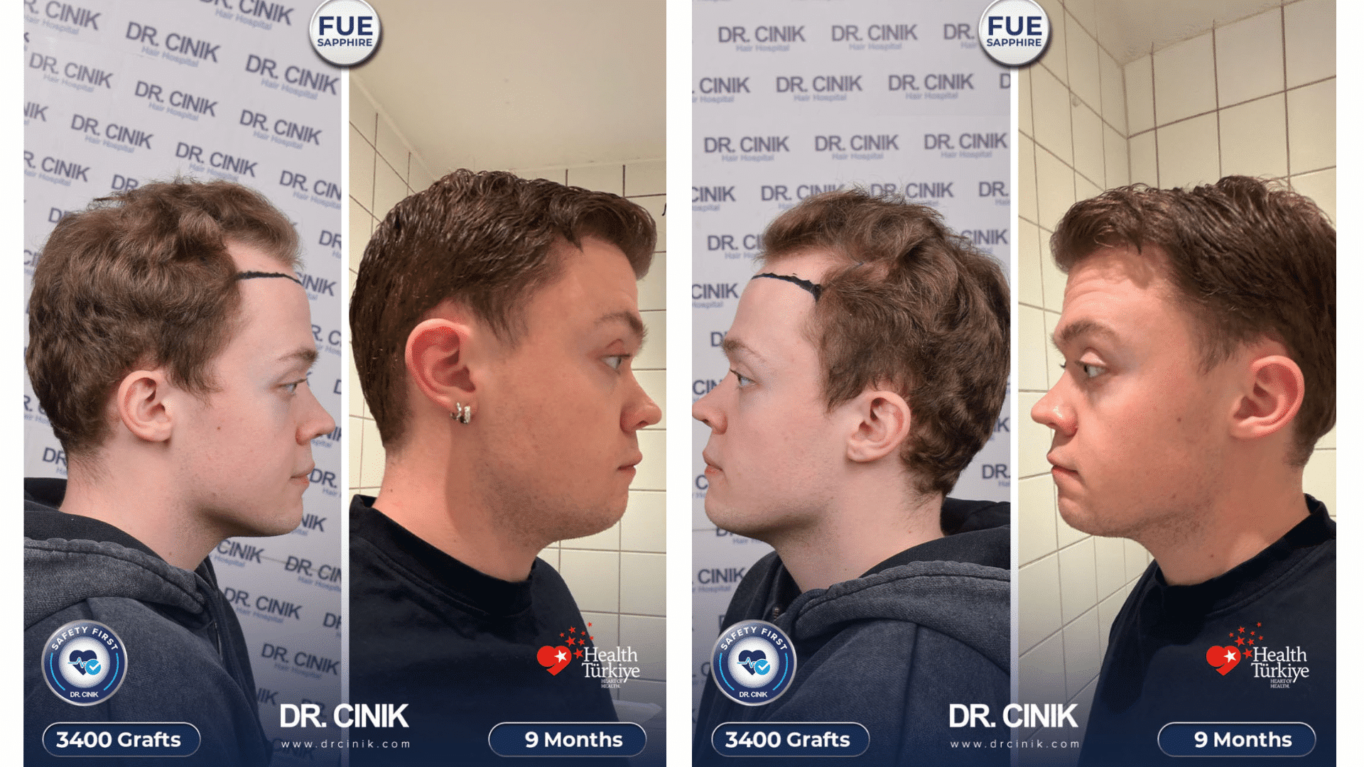 Mikkel's hair transplant at 9 months, side profiles and intact donor area, 3400 grafts Sapphire FUE