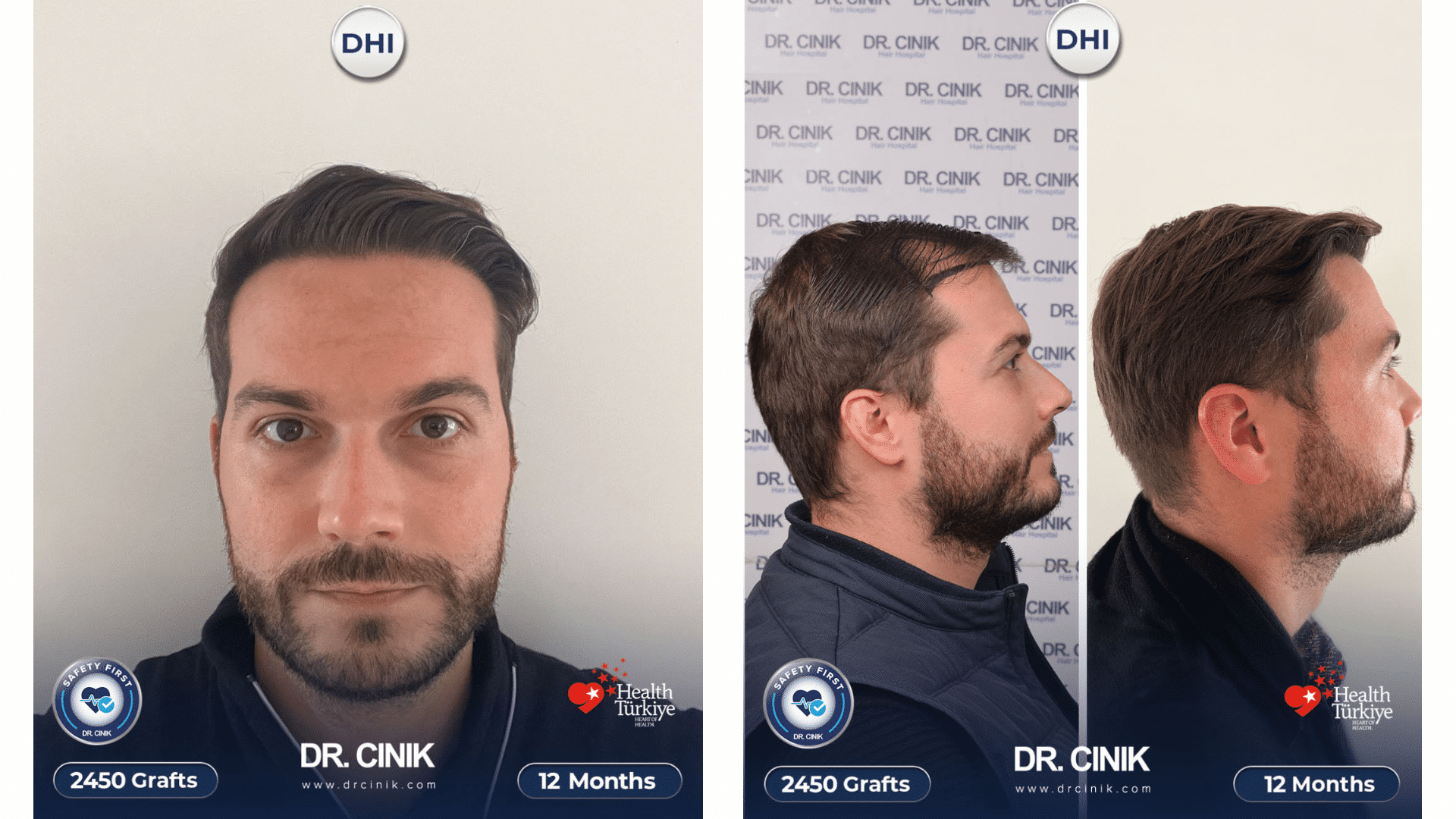 Greffe de cheveux de Xavier, résultat à 12 mois, de face et de profil, 2450 greffons