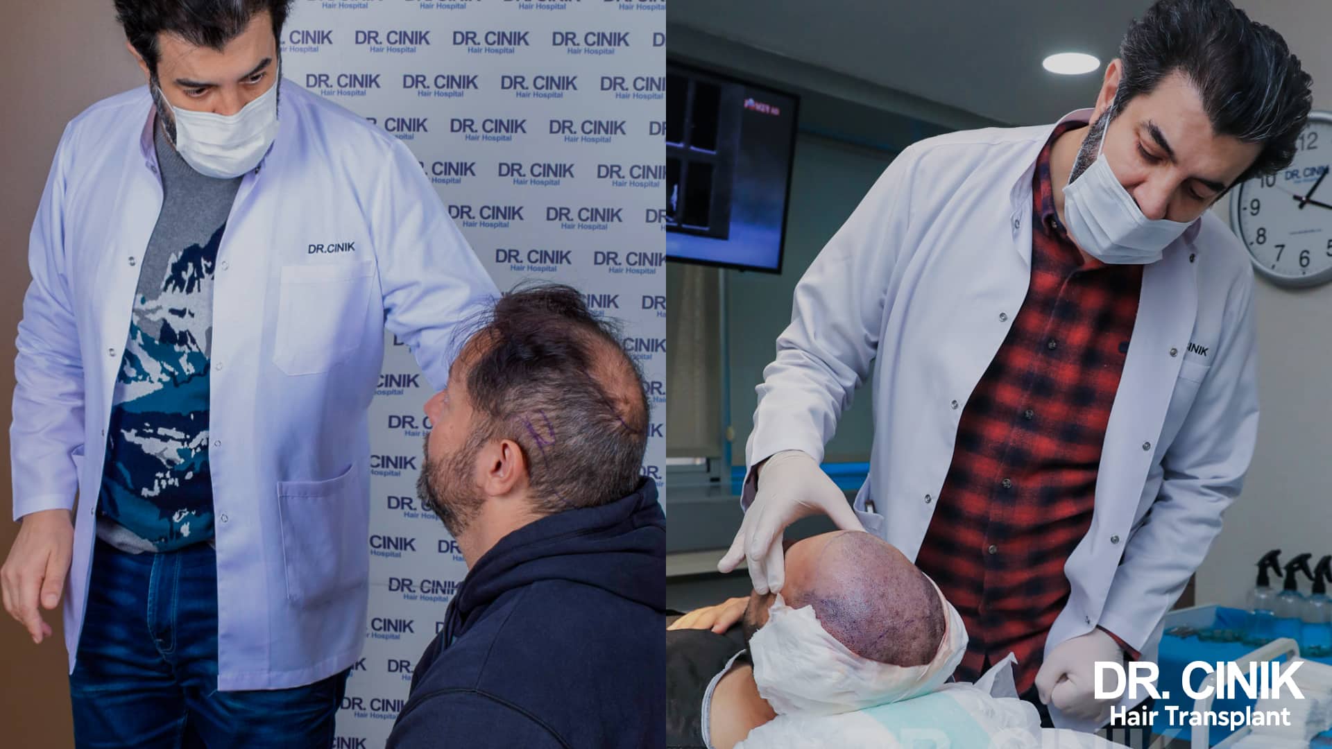 Why a hair transplant is not the answer for alopecia areata