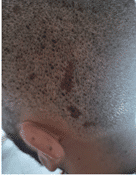 Small bruises behind the ear in the donor area, six days after a hair transplant