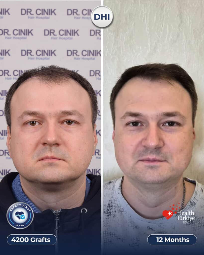 Oleg's hair transplant before and after, 4200 grafts DHI, front view before the operation then the result at 12 months