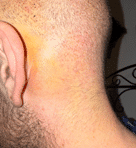 Scalp swelling six days after a hair transplant