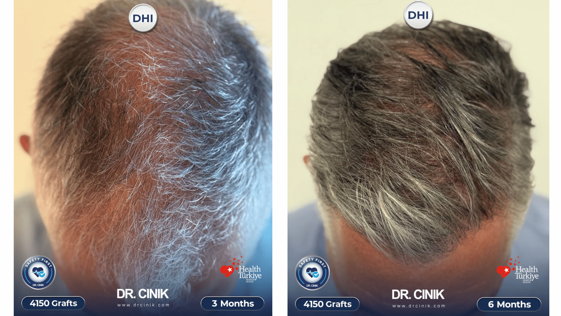 Top view of Matthias's scalp at 3 months then 6 months after the DHI transplant of 4150 grafts, coverage clearly thickening