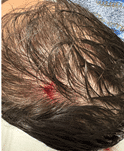 Light scalp bleeding after scratching, four months after a hair transplant