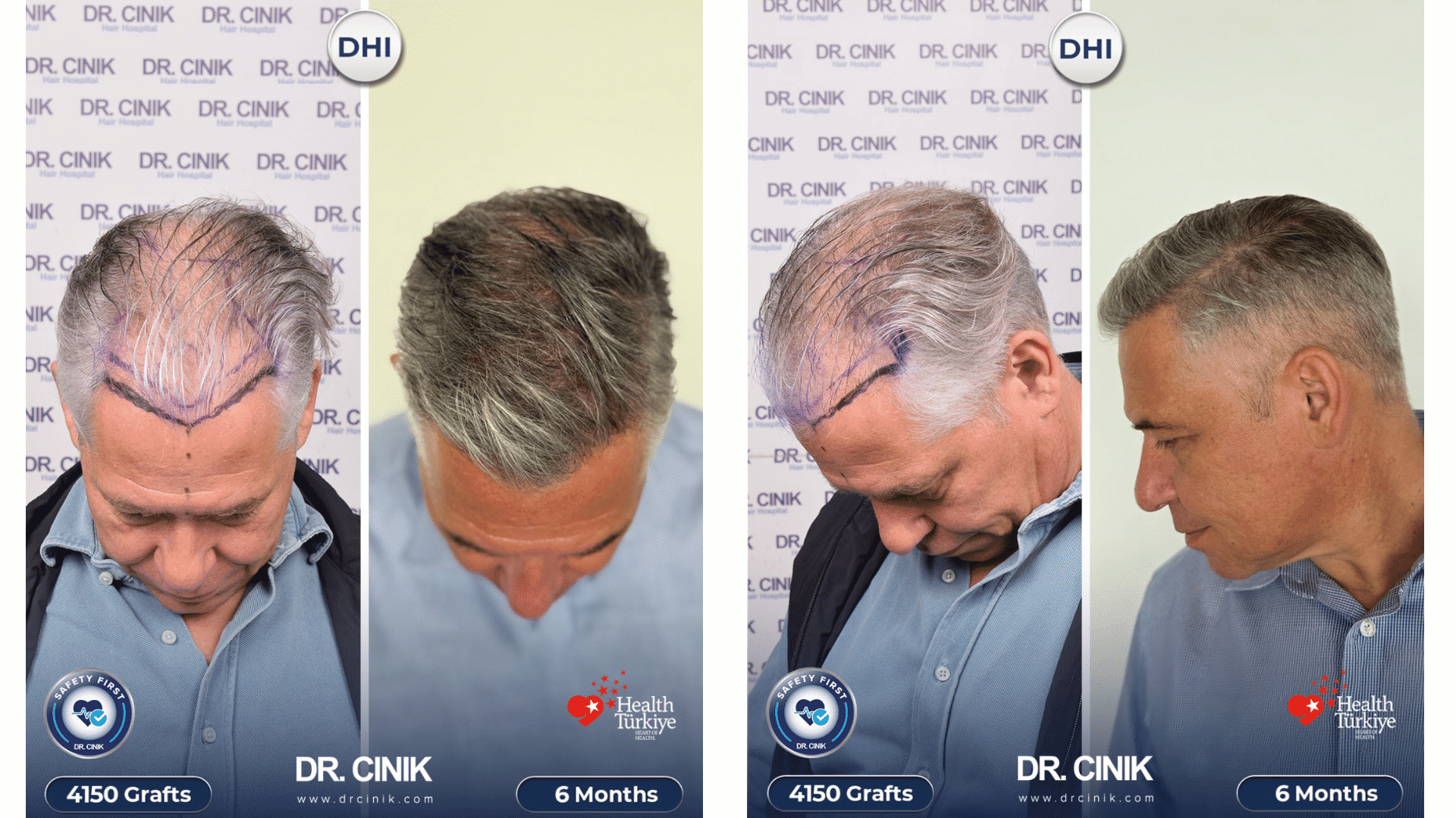Matthias before and after at 6 months, top and profile views, hairline and temple points rebuilt on gray hair