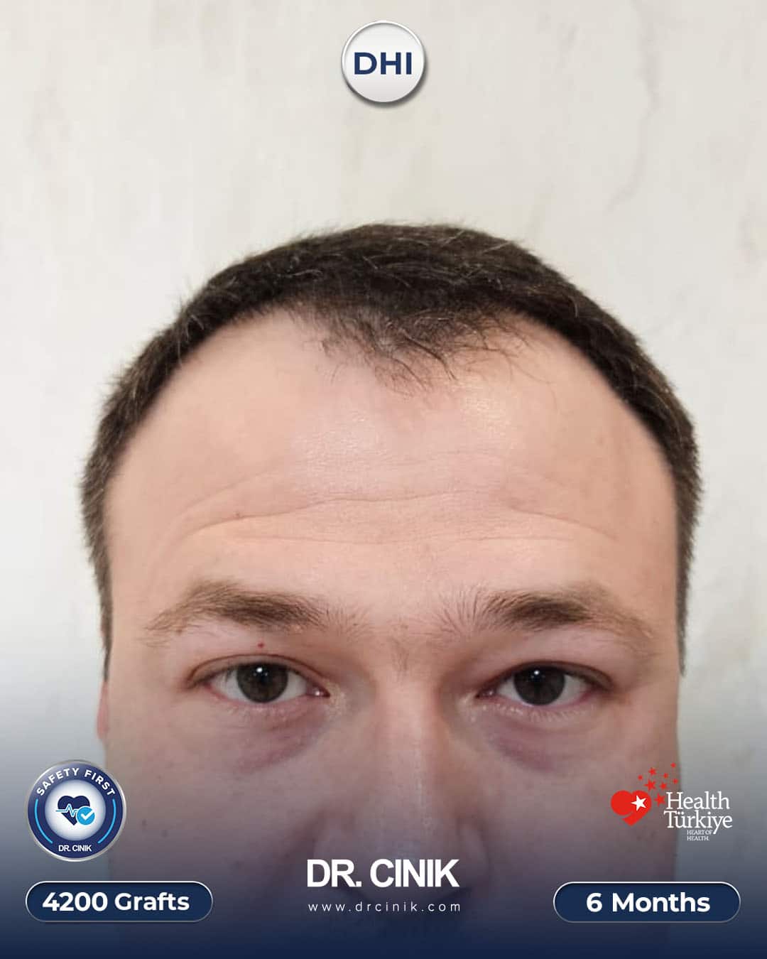 Densità dei capelli di Oleg a 6 mesi dal trapianto DHI, fronte e parte centrale della testa nettamente più folte