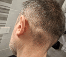 Swollen lymph node at the back of the head, four months after a hair transplant