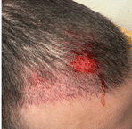 Open wound on the scalp after a car accident following a hair transplant