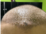 Scalp swelling eleven days after a hair transplant