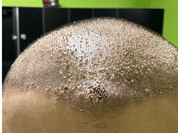 Scalp swelling eleven days after a hair transplant, wider view