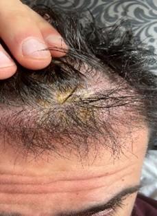 Crusting on the scalp four months after a hair transplant in a patient with a history of psoriasis