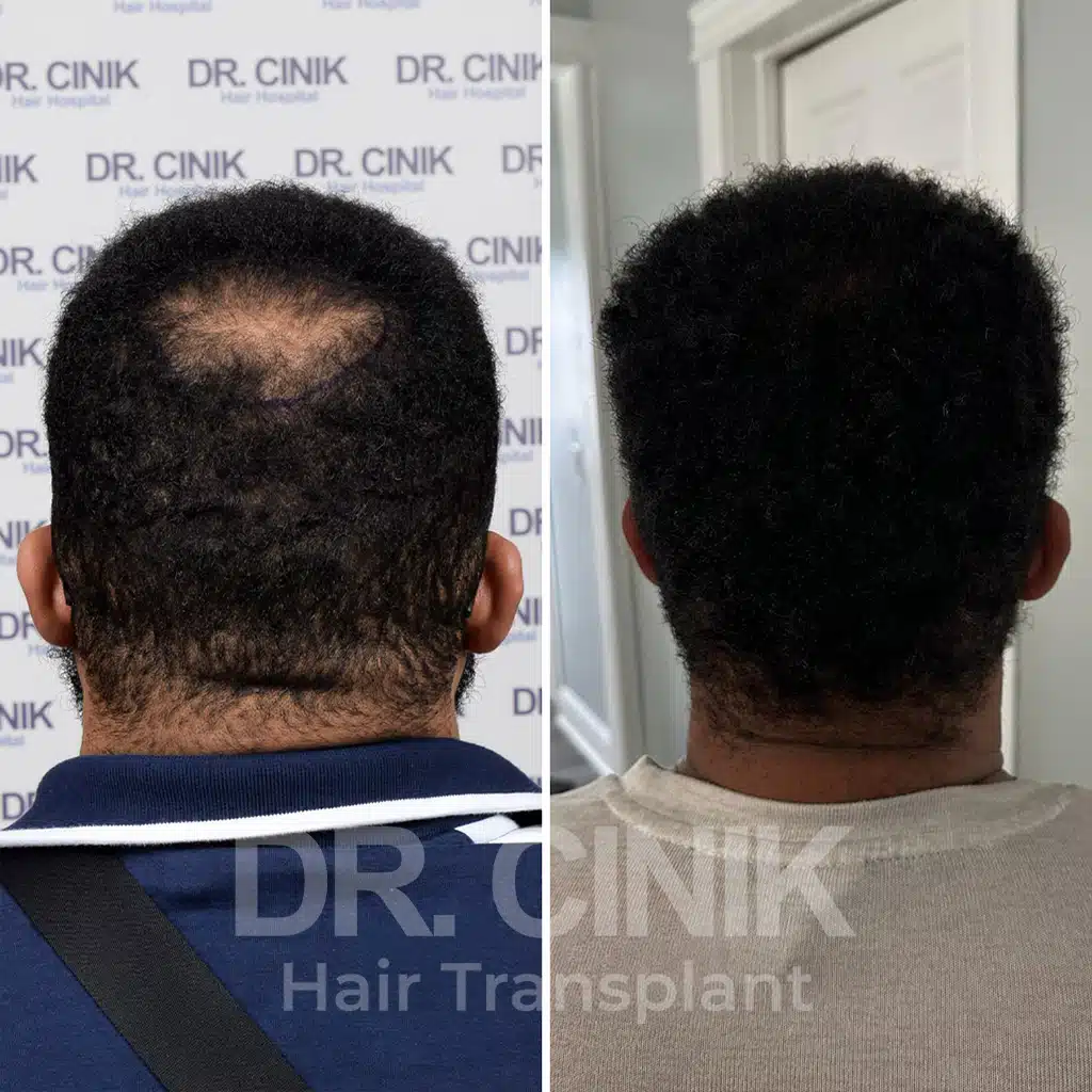 Comparación antes y después de un trasplante capilar afro con 1700 injertos, mostrando la transformación tras el procedimiento.
