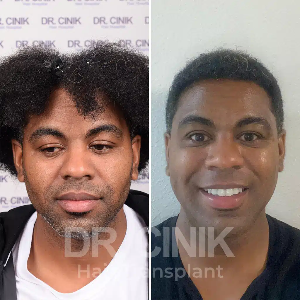 Comparación antes y después de un trasplante capilar afro con 2000 injertos. Patrón inicial Norwood IV mostrando la transformación.