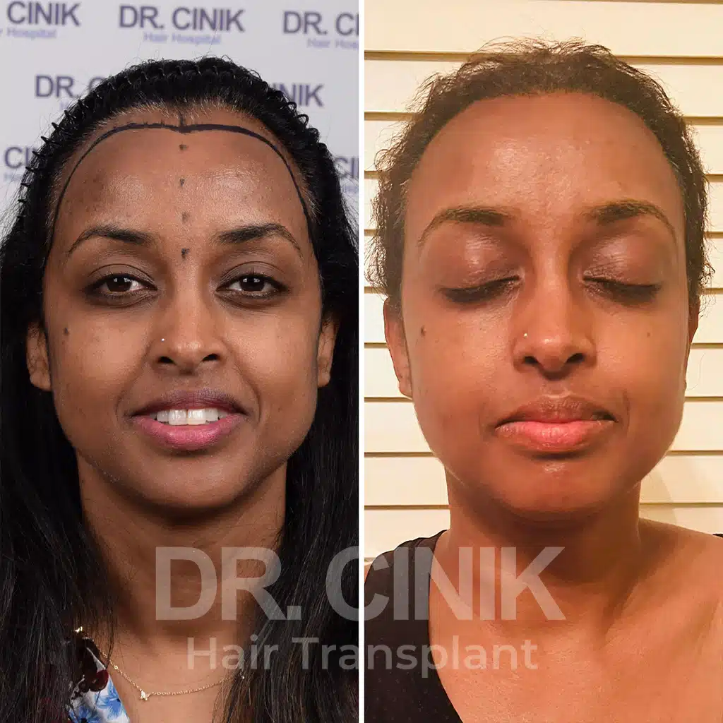 Comparación antes y después de un trasplante capilar afro con 2050 injertos, mostrando la transformación tras el procedimiento.