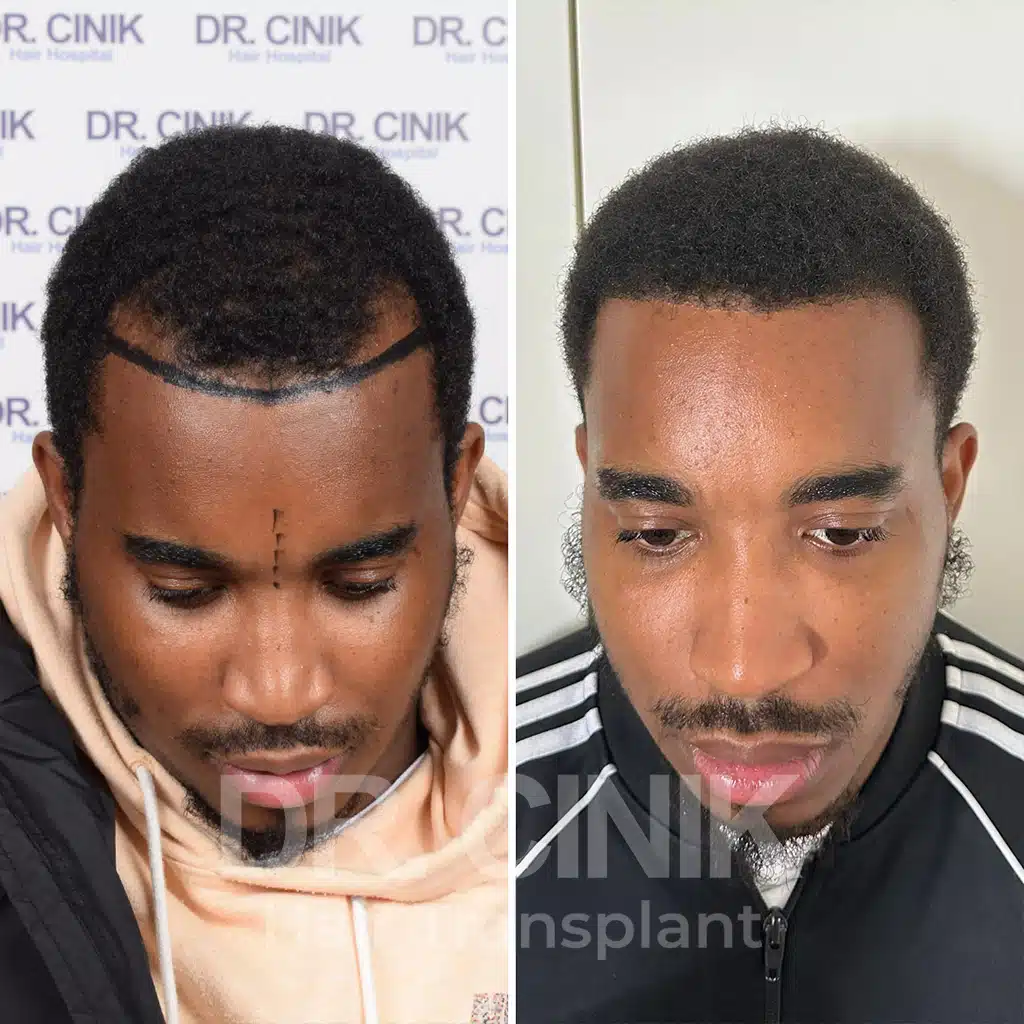 Comparación antes y después de un trasplante capilar afro con 2200 injertos. Patrón inicial Norwood I mostrando la transformación.