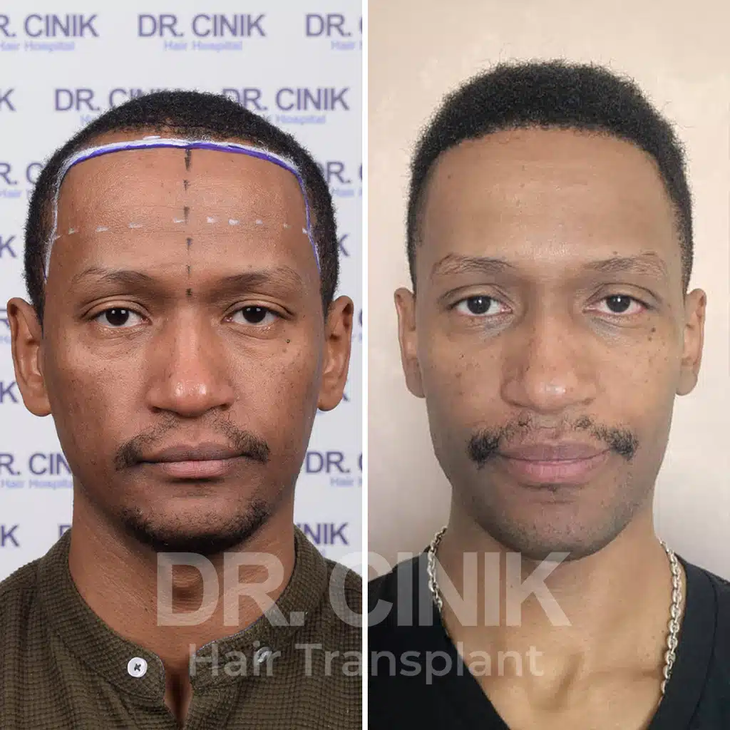 Comparación antes y después de un trasplante capilar afro con 2350 injertos, mostrando la transformación tras el procedimiento.
