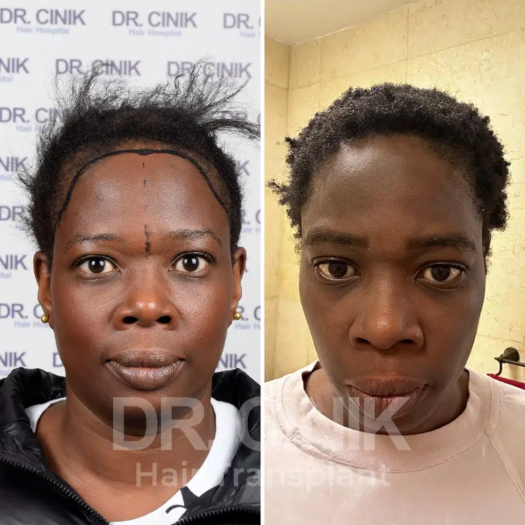 Comparación antes y después de un trasplante capilar afro con 2400 injertos. Patrón inicial Norwood V mostrando la transformación.