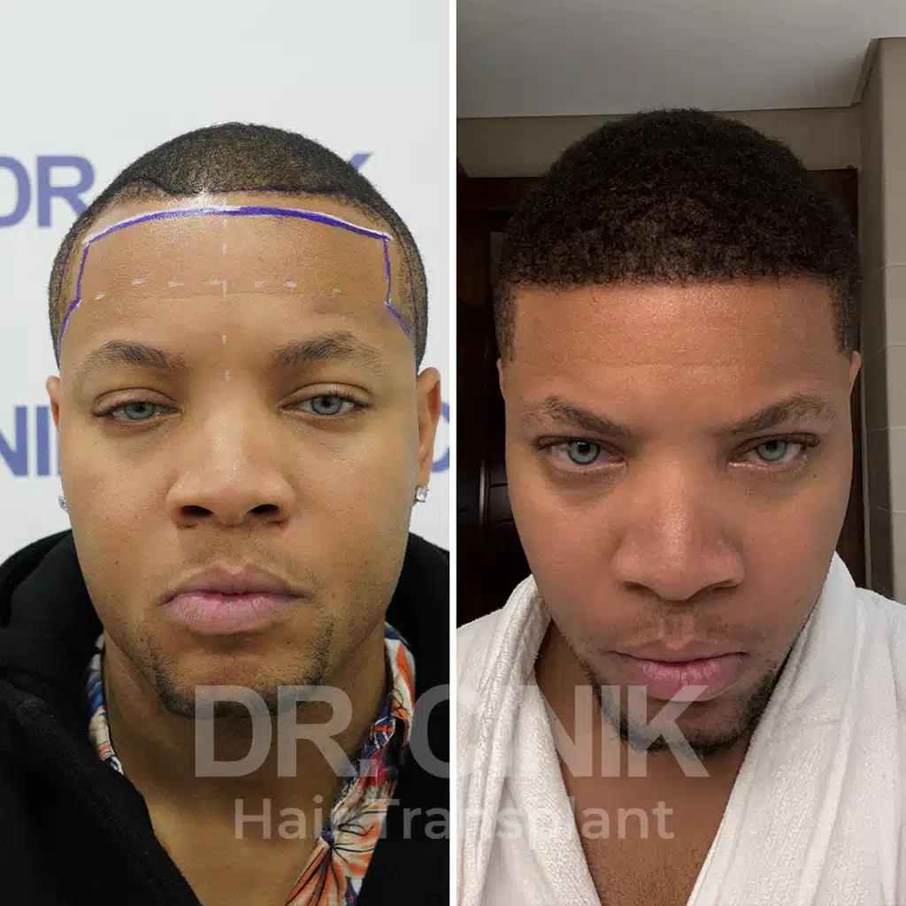Comparación antes y después de un trasplante capilar afro con 2495 injertos. Patrón inicial Norwood III mostrando la transformación.