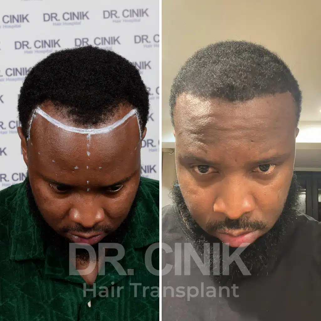 Comparación antes y después de un trasplante capilar afro con 2500 injertos. Patrón inicial Norwood IV mostrando la transformación.