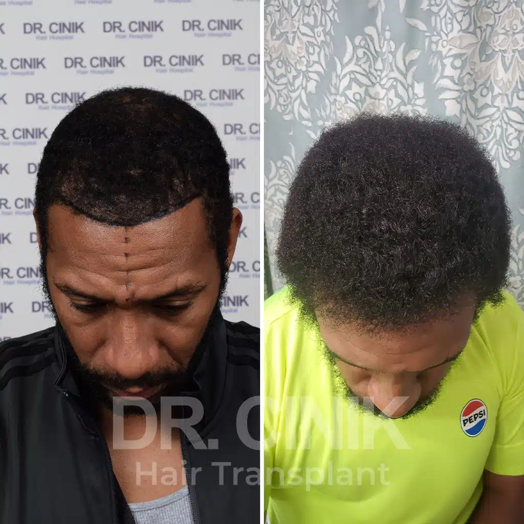 Comparación antes y después de un trasplante capilar afro con 2500 injertos. Patrón inicial Norwood V mostrando la transformación.