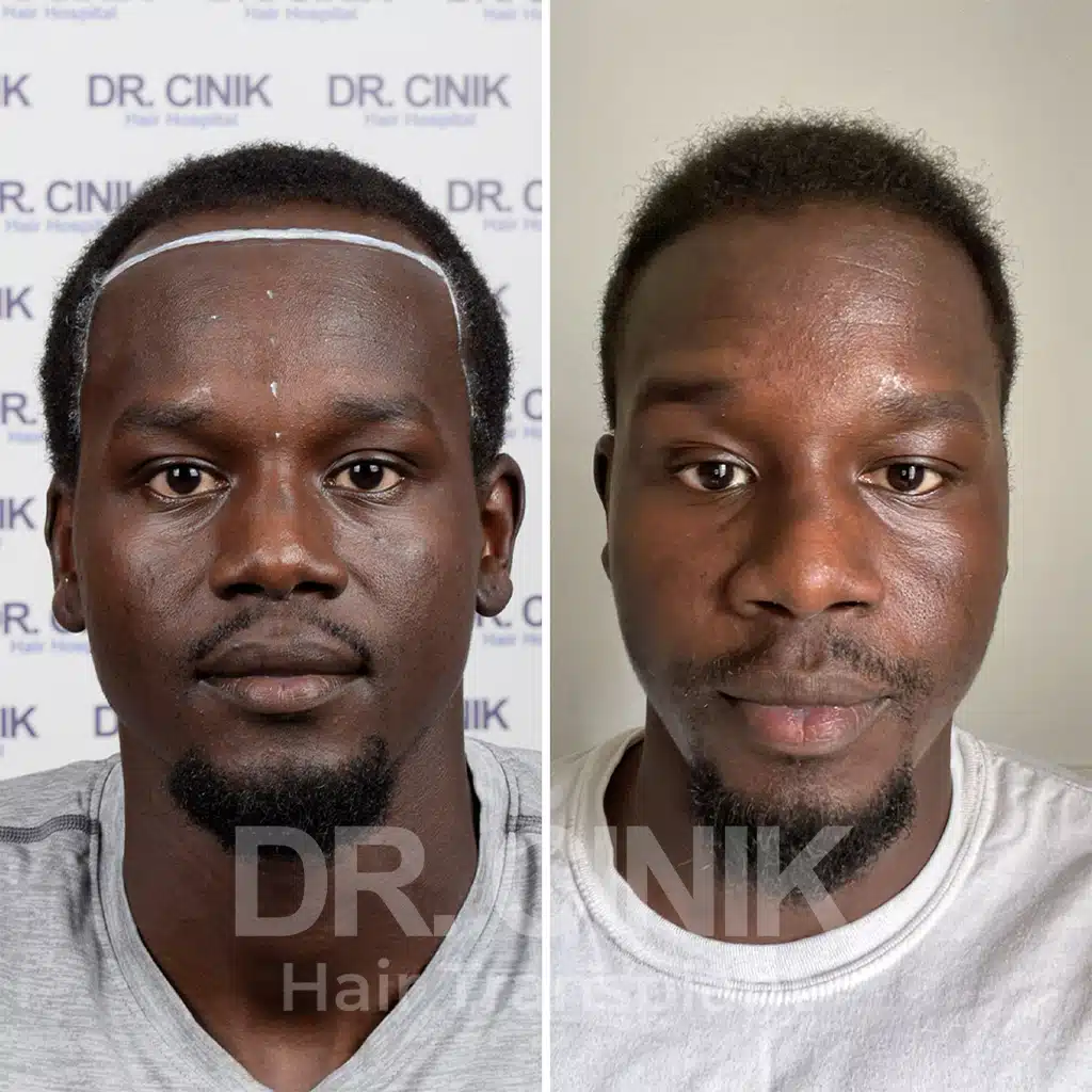 Comparación antes y después de un trasplante capilar afro con 2750 injertos, mostrando la transformación tras el procedimiento.