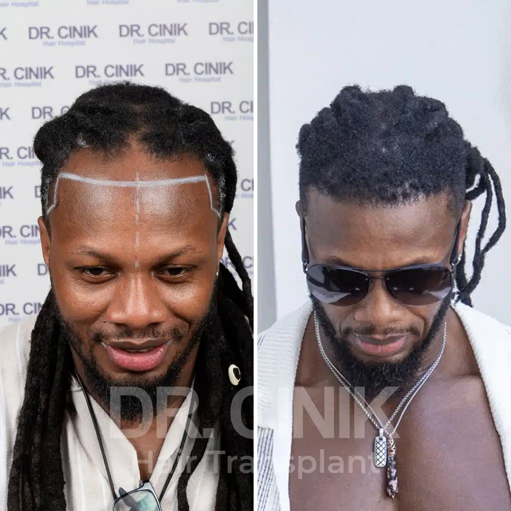 Comparación antes y después de un trasplante capilar afro con 2800 injertos, mostrando la transformación tras el procedimiento.
