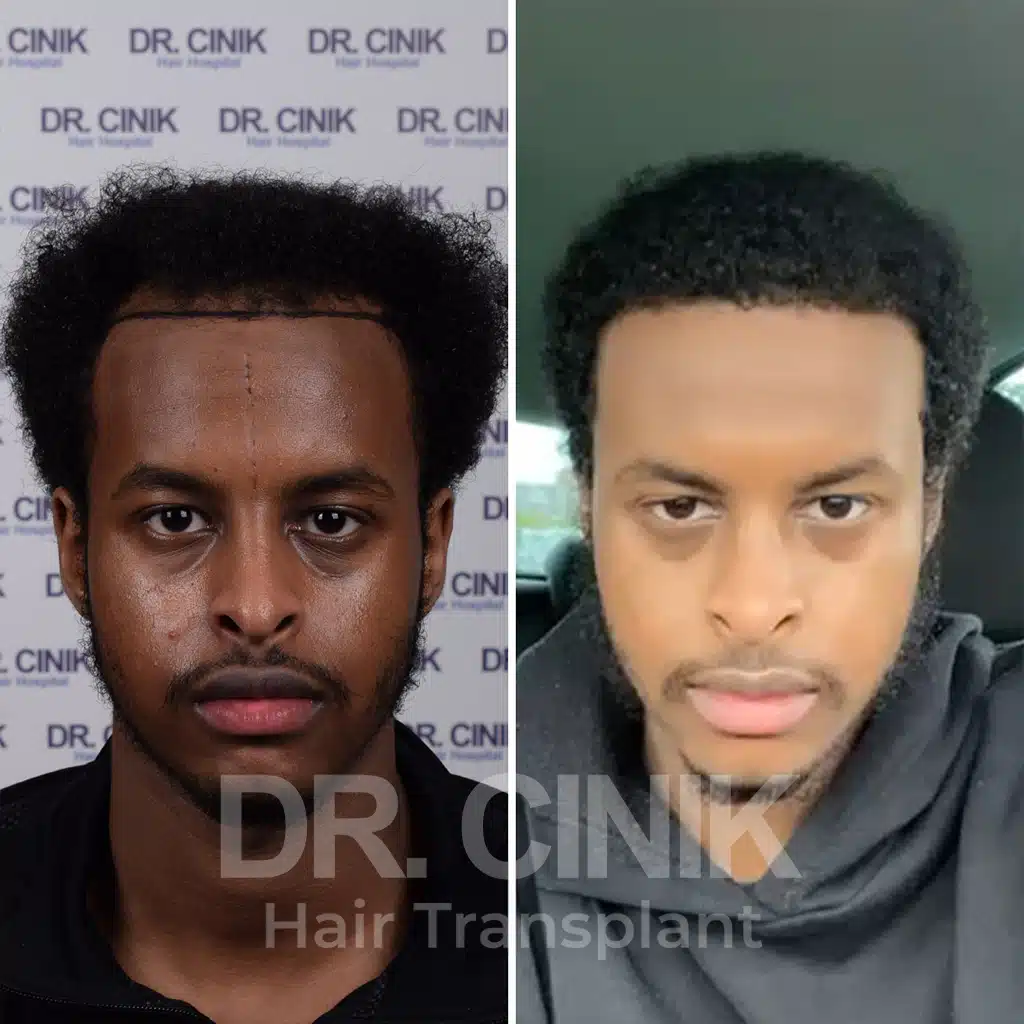 Comparación antes y después de un trasplante capilar afro con 2800 injertos. Patrón inicial Norwood III mostrando la transformación.