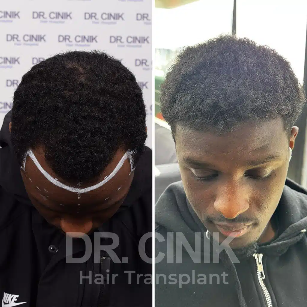 Comparación antes y después de un trasplante capilar afro con 2850 injertos. Patrón inicial Norwood III mostrando la transformación.
