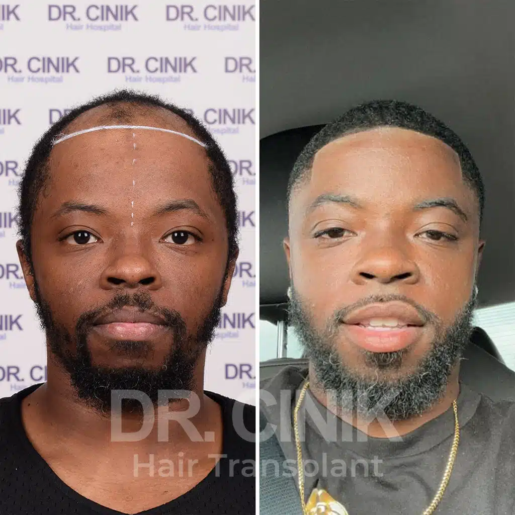 Comparación antes y después de un trasplante capilar afro con 3000 injertos. Patrón inicial Norwood V mostrando la transformación.