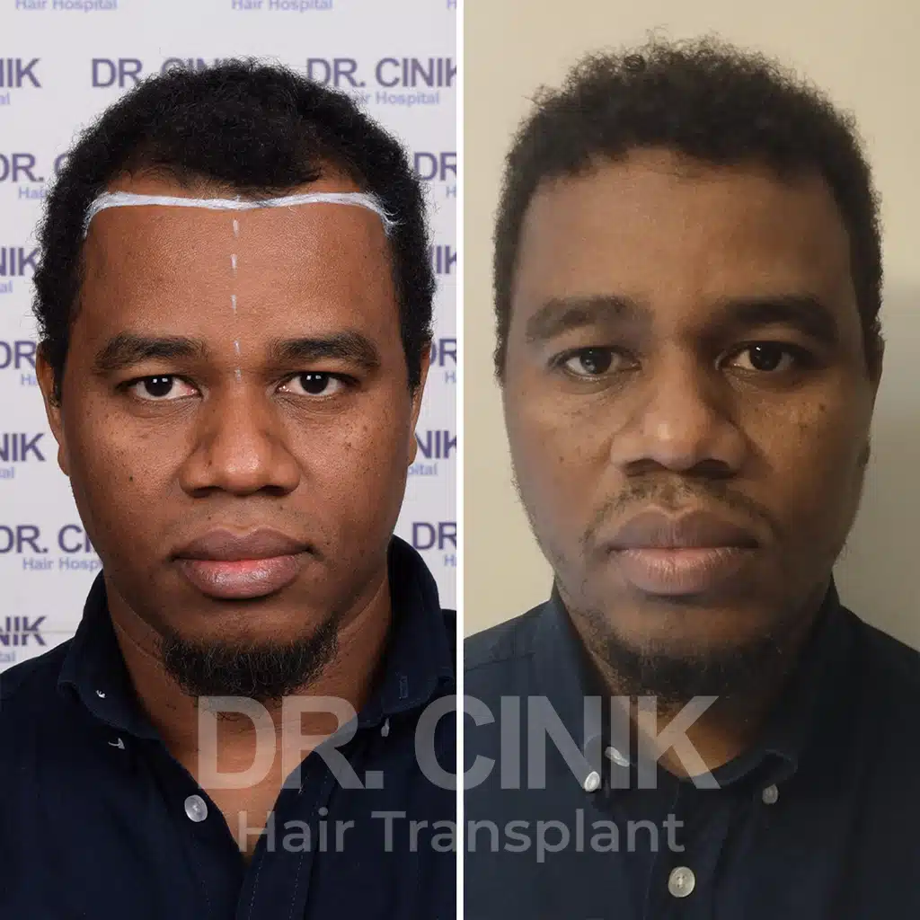 Comparación antes y después de un trasplante capilar afro con 3025 injertos. Patrón inicial Norwood IV mostrando la transformación.