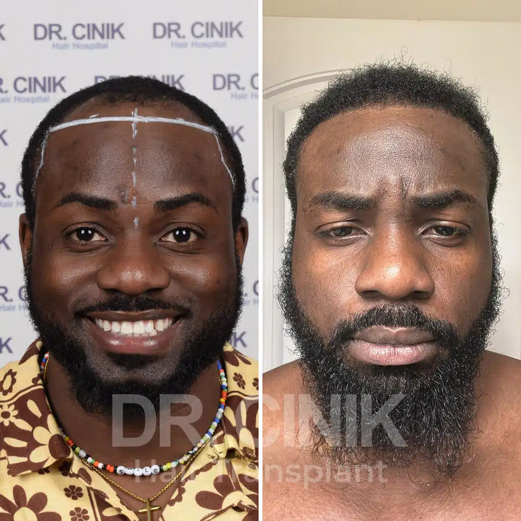 Comparación antes y después de un trasplante capilar afro con 3050 injertos. Patrón inicial Norwood IV mostrando la transformación.