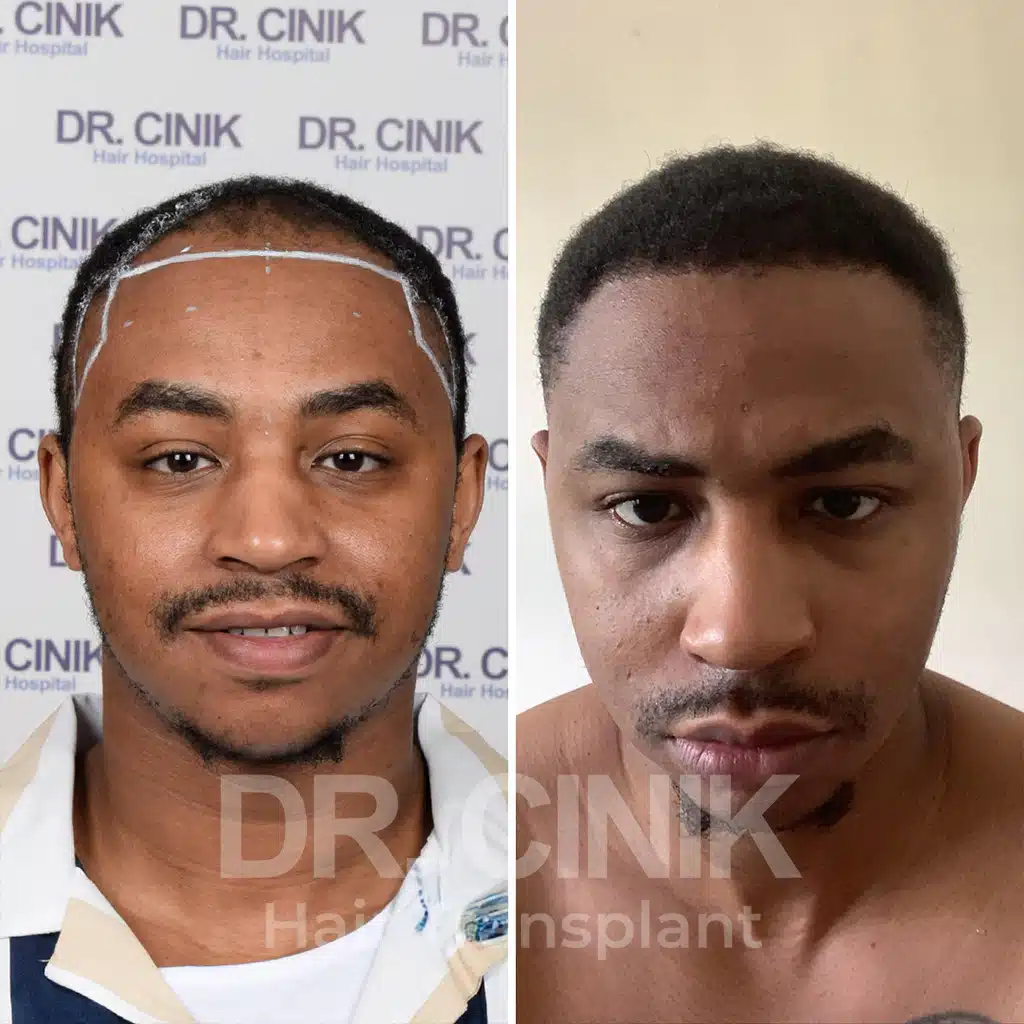 Comparación antes y después de un trasplante capilar afro con 3200 injertos, mostrando la transformación tras el procedimiento.