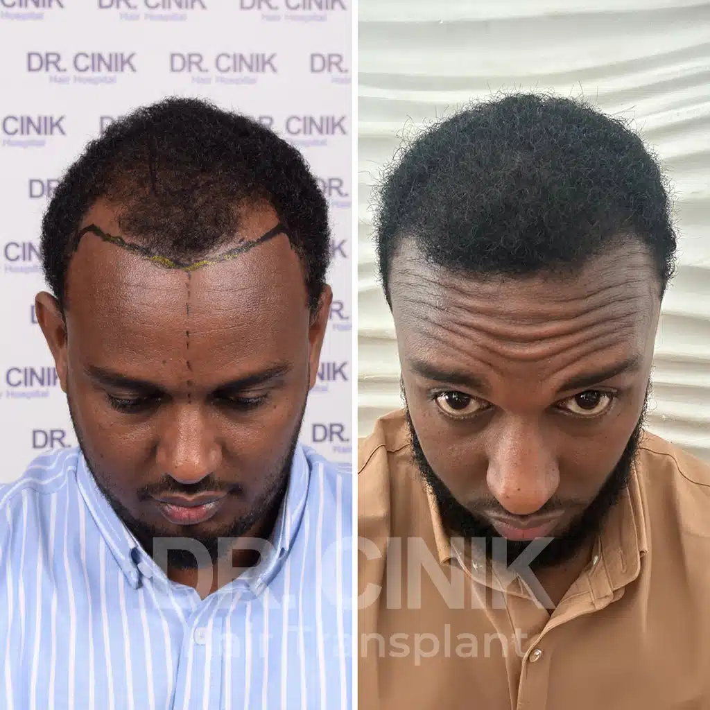 Comparación antes y después de un trasplante capilar afro con 3200 injertos. Patrón inicial Norwood V mostrando la transformación.