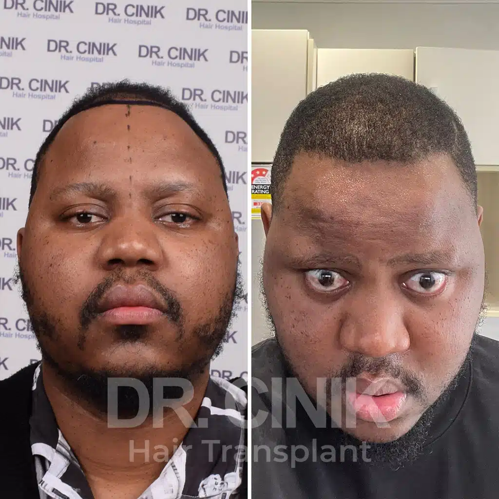 Comparación antes y después de un trasplante capilar afro con 3200 injertos. Patrón inicial Norwood V mostrando la transformación.