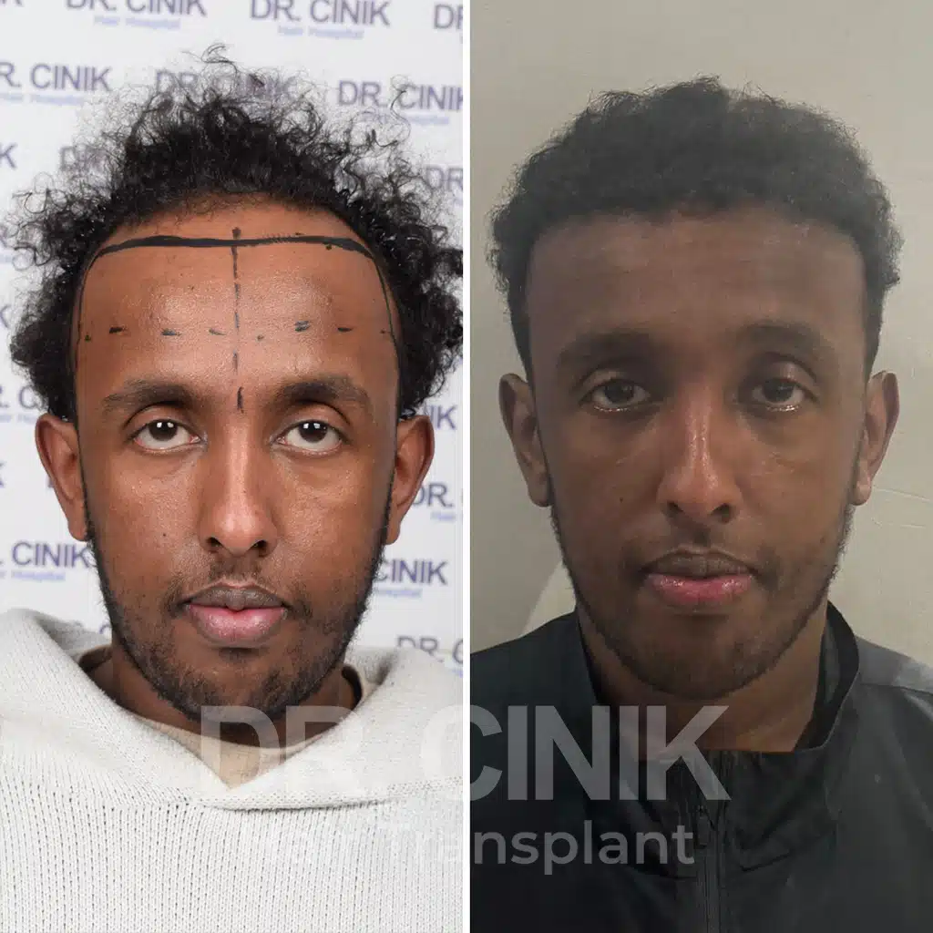 Comparación antes y después de un trasplante capilar afro con 3200 injertos. Patrón inicial Norwood V mostrando la transformación.