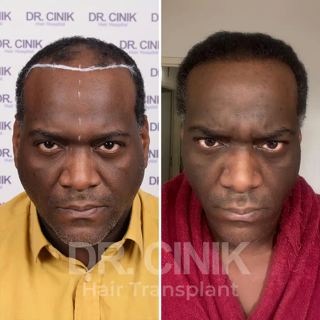 Comparación antes y después de un trasplante capilar afro con 3200 injertos. Patrón inicial Norwood V mostrando la transformación.