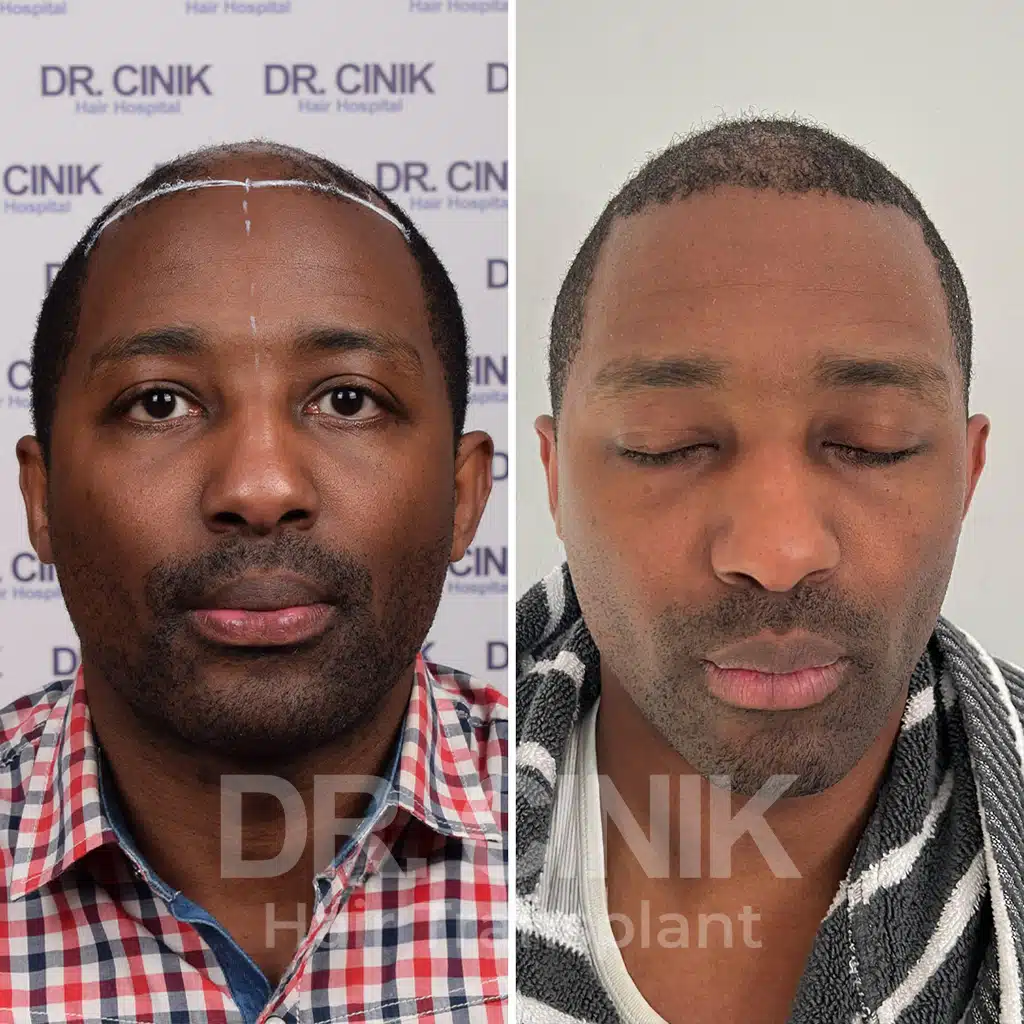 Comparación antes y después de un trasplante capilar afro con 3360 injertos. Patrón inicial Norwood V mostrando la transformación.