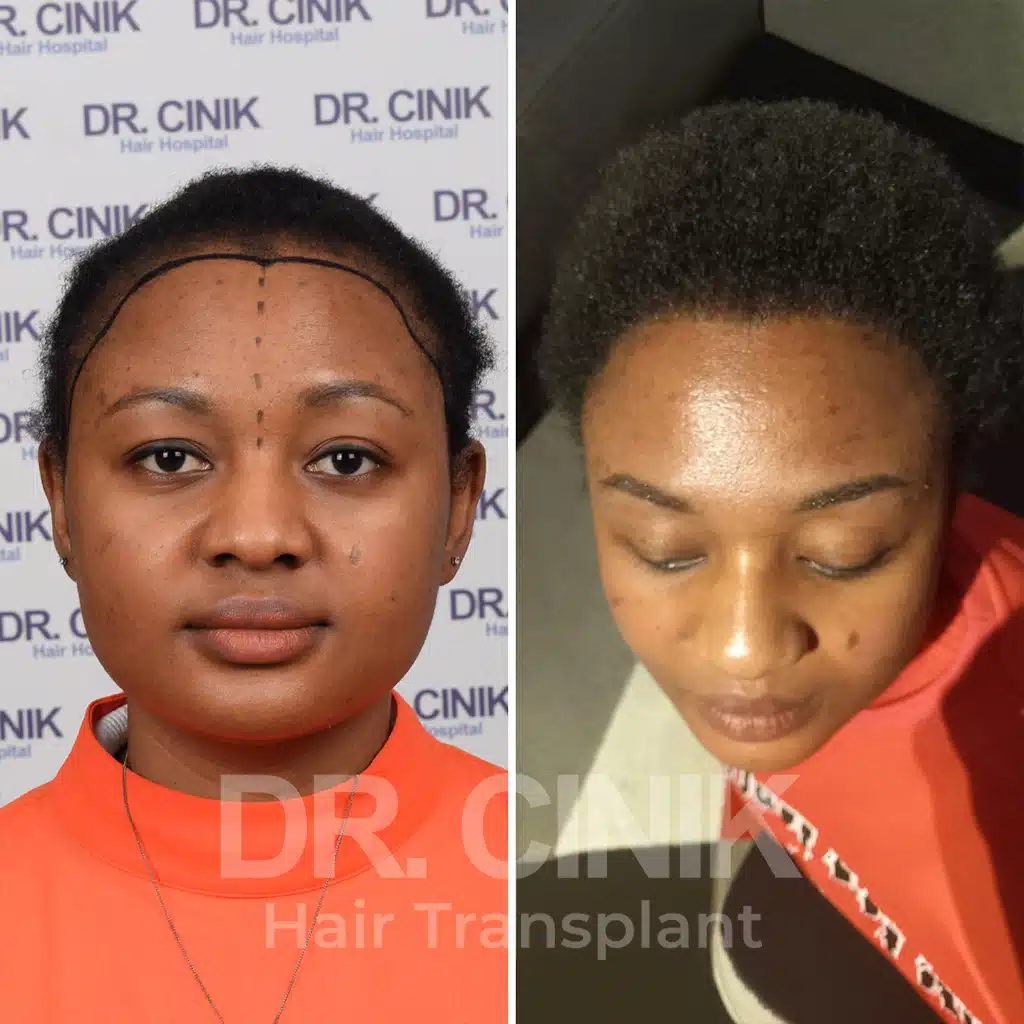 Comparación antes y después de un trasplante capilar afro con 3400 injertos, mostrando la transformación tras el procedimiento.